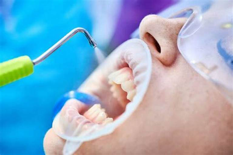 سندبلاست در دندان پزشکی